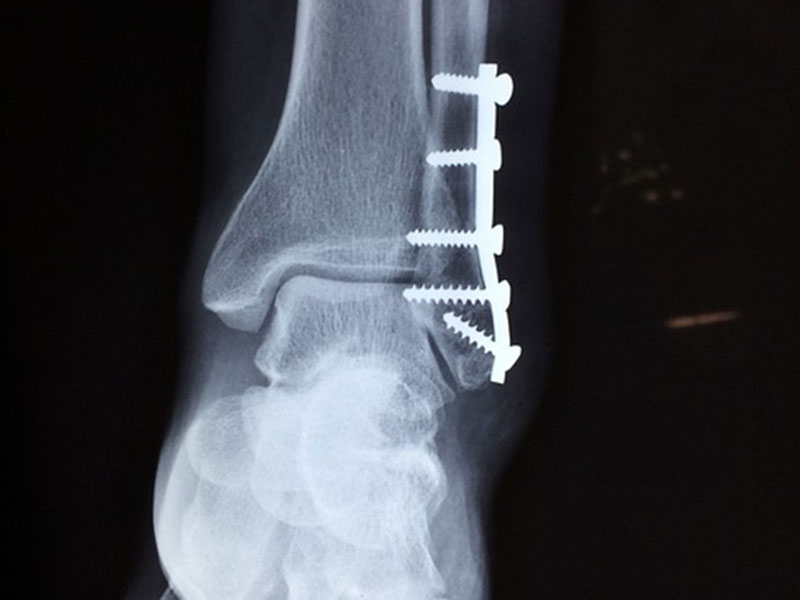 physiotherapy glasgow